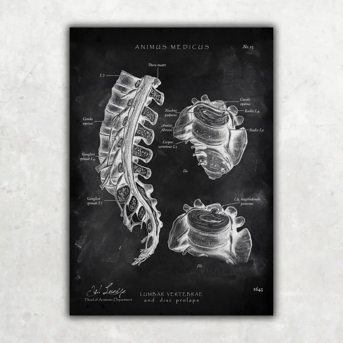 Bandscheibenvorfall Anatomie - Chalkboard - Animus Medicus GmbH