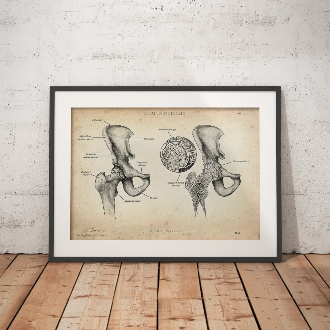 Hip Osteoarthritis