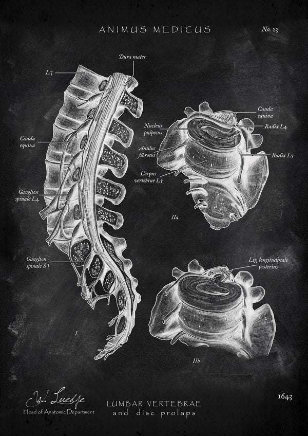 Herniated Disc Anatomy - Chalkboard