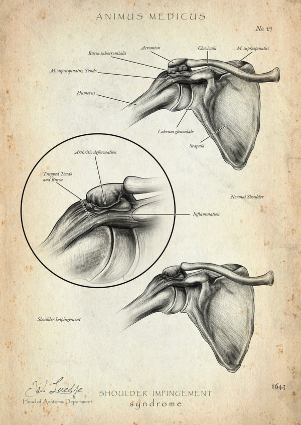 Shoulder Impingement