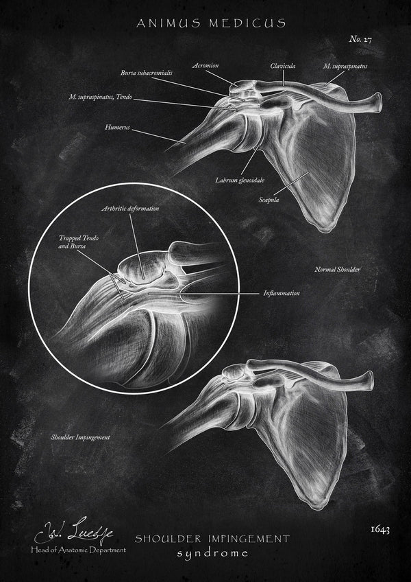 Shoulder Impingement - Chalkboard