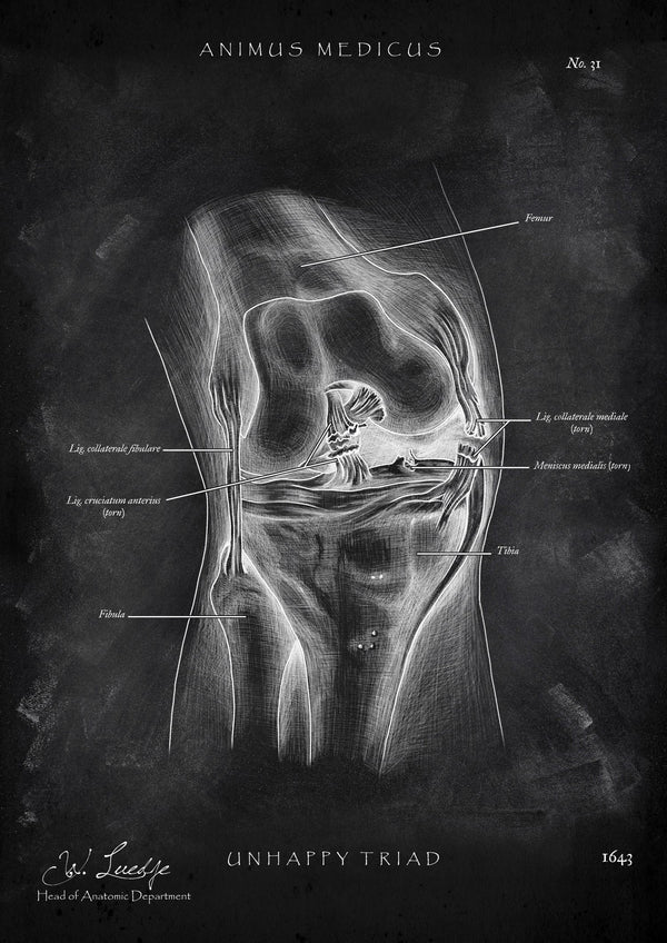 Unhappy Triad Knee - Chalkboard