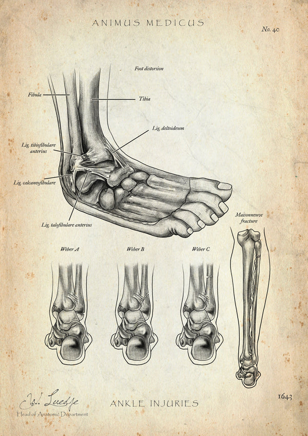 Ankle joint with torn ligament