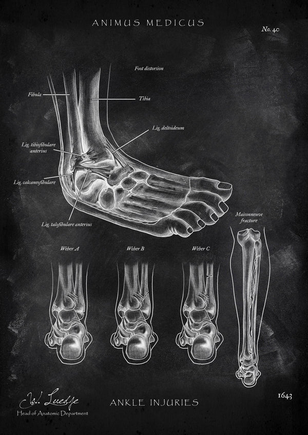 Ankle joint with torn ligament - Chalkboard