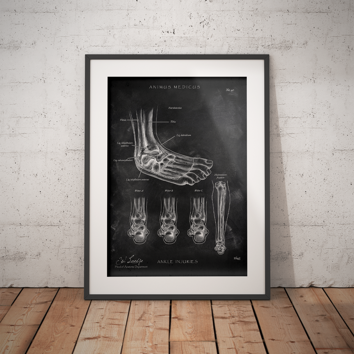 Ankle joint with torn ligament - Chalkboard