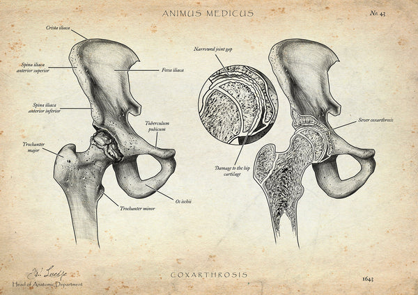 Hip Osteoarthritis