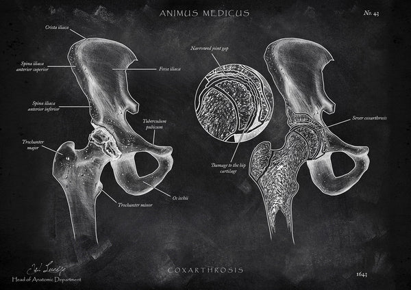 Hip Osteoarthritis - Chalkboard