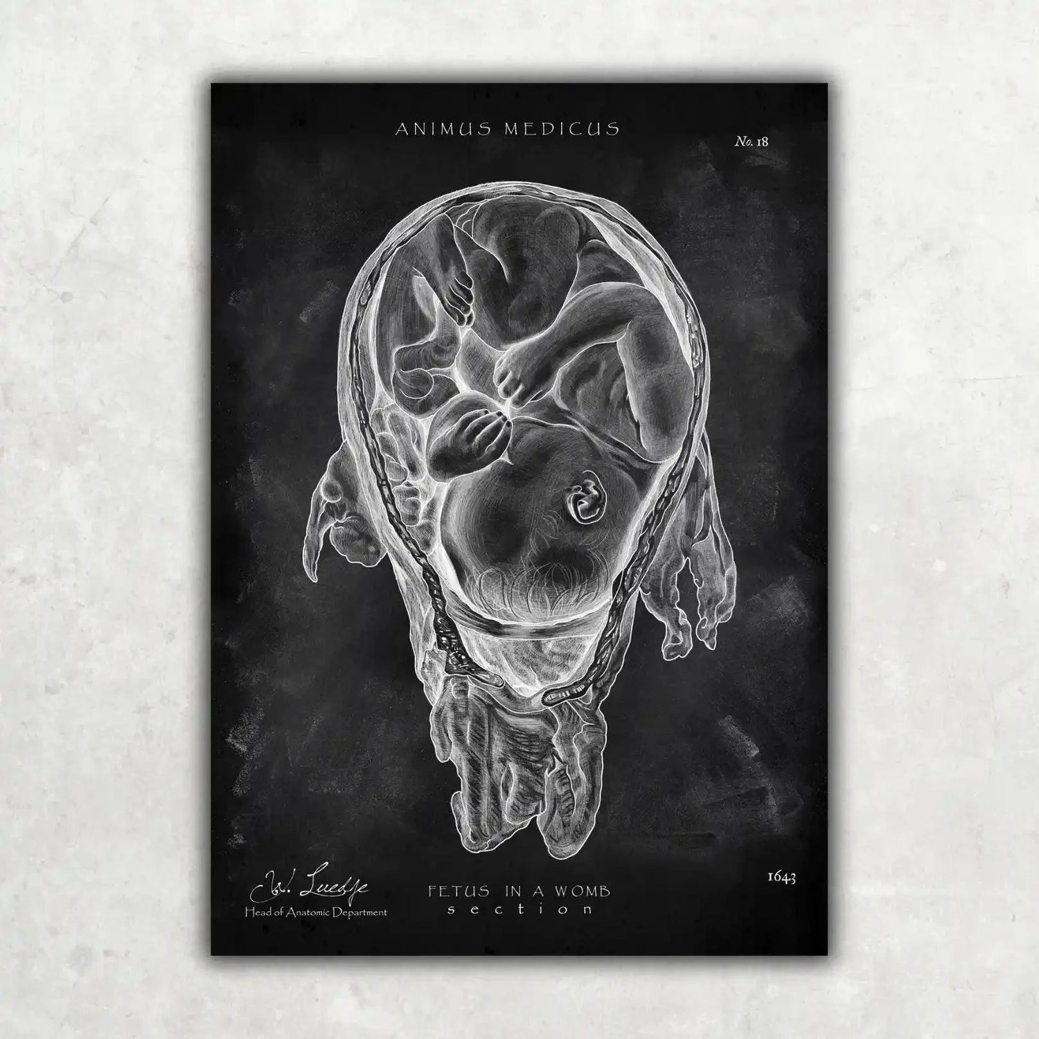 Baby in Gebärmutter - Chalkboard - Animus Medicus GmbH
