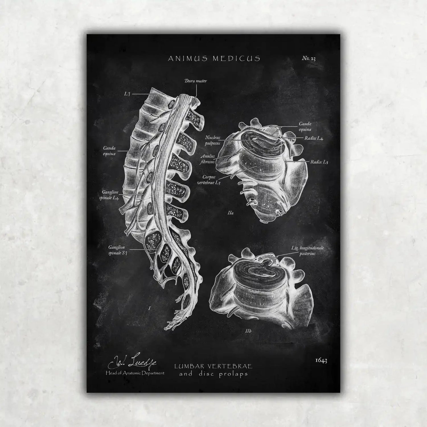Bandscheibenvorfall Anatomie - Chalkboard - Animus Medicus GmbH
