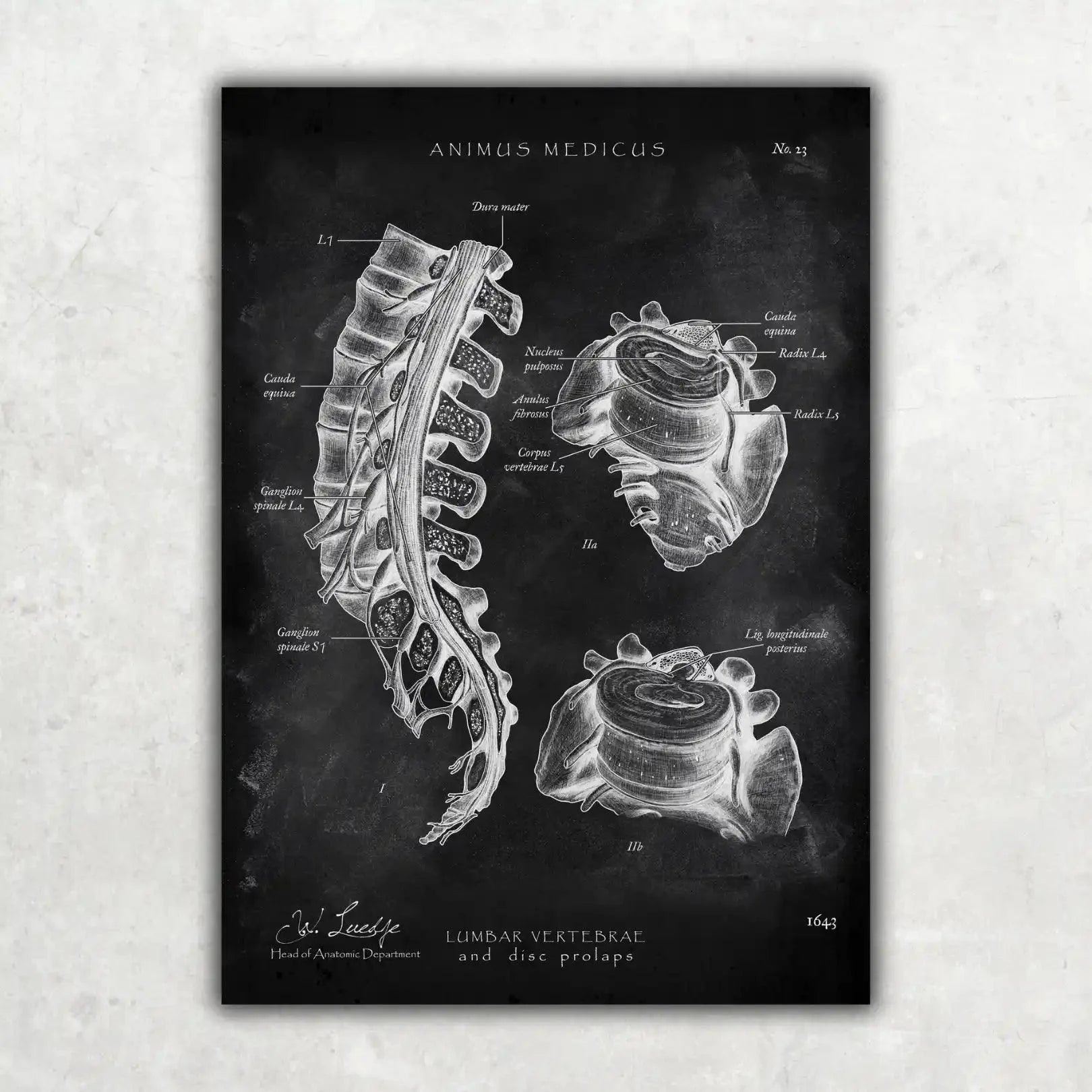 Bandscheibenvorfall Anatomie - Chalkboard - Animus Medicus GmbH