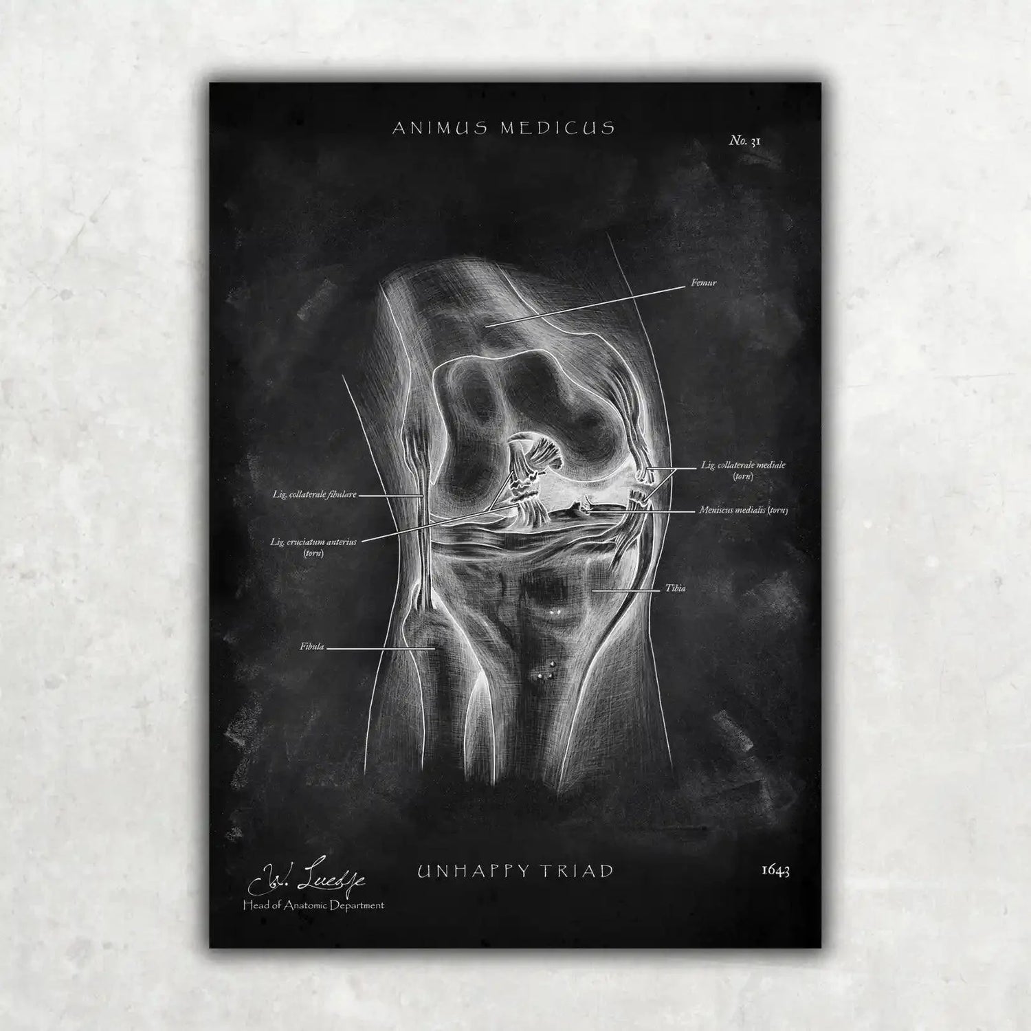 Unhappy Triad Knie - Chalkboard - Animus Medicus GmbH